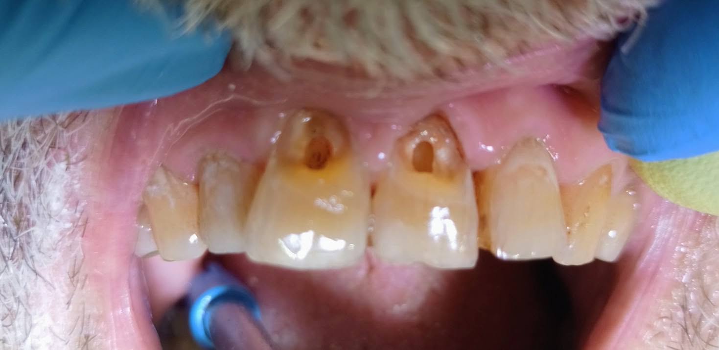 Reconstrucción de dientes frontales — Antes