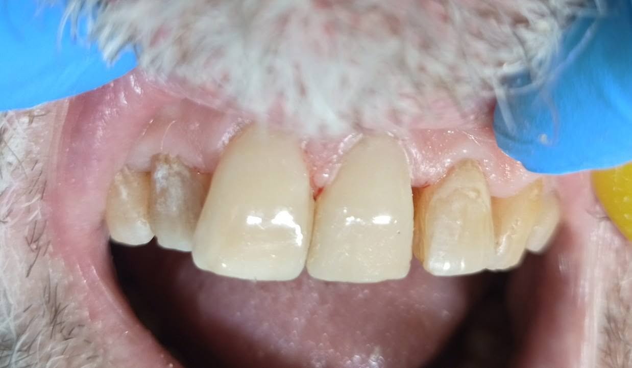 Reconstrucción de dientes frontales — Después